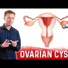 Ovarian Cysts: Causes, Symptoms and a Natural Treatment