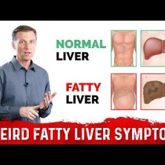 3 Weird Symptoms of a Fatty Liver