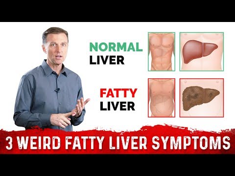 3 Weird Symptoms of a Fatty Liver