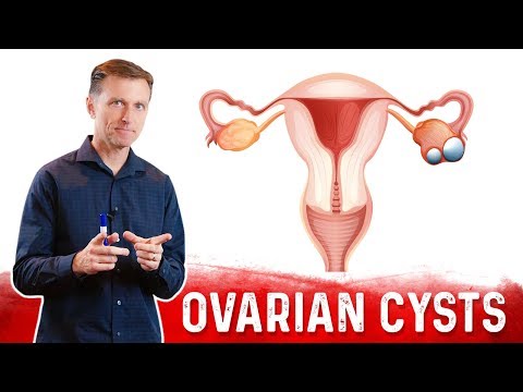 Ovarian Cysts: Causes, Symptoms and a Natural Treatment